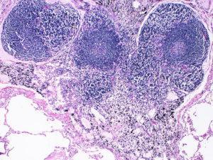 Intrapulmonary lymph node